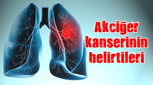 Akciğer kanserinin belirtileri nelerdir?