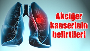 Akciğer kanserinin belirtileri nelerdir?