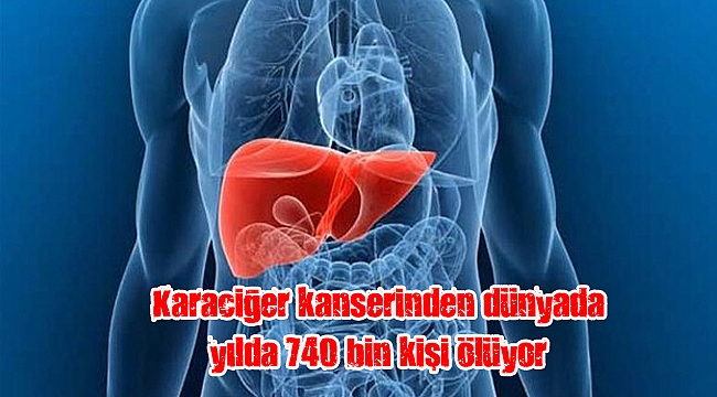 Karaciğer kanserinden dünyada yılda 740 bin kişi ölüyor