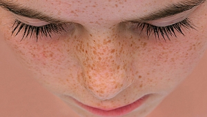 Pigment lekelerini yok edin