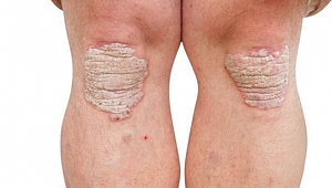 Sedef hastalığı nasıl geçer?