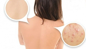 Sırttaki sivilcelerden kurtulmanın yolu