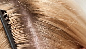 Kepek nedir? Neden olur?