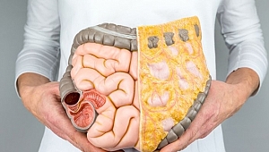 Kolon kanserine neden olan etkenler