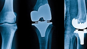 Diz protezi ömürlük bir ameliyat mıdır?