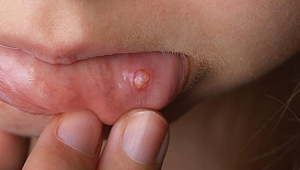 Aft yaralarından çabucak kurtulun