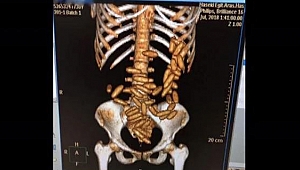 Turistin midesinden uyuşturucu çıktı