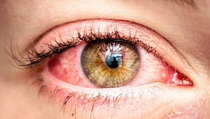 Gözlerde oluşan kanlanmalara dikkat!
