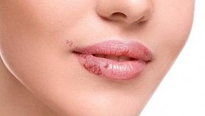 Herpes simplex nedir?