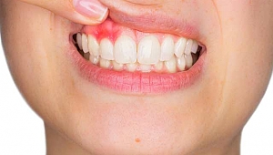 Diş eti kanaması tehlikeli midir?