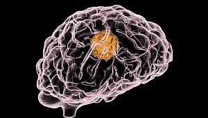 Beyin kanseri erkekleri daha çok etkiliyor