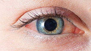 Göz alerjileri göz kaybına neden olabilir