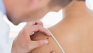 Aniden koyulaşan ve büyüyen benlere dikkat!