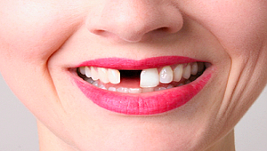 Kilo almanın sebebi eksik diş mi?