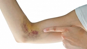 Vücuttaki morluklar için çözümler