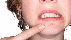 Aknelerin sebebi bağırsak florası olabilir