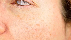 Güneş lekesi için kalıcı tedavi yöntemi var mıdır?