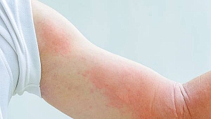 İsilik nasıl olur, ne kadar sürer?