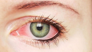 Göz kuruluğu için tedavi yöntemleri