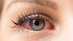 Sıcak hava göz enfeksiyonlarını arttırıyor