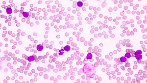 Akut lösemide her zaman umut var