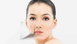 Aknelerle nasıl mücadele edilmeli?