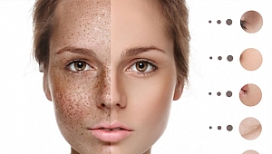 Cilt lekeleri kabusunuz olmasın