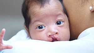 Nager sendromu nedir?