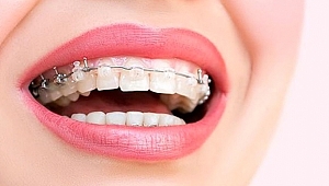 Bozuk diş yapısı mutsuzluk ve depresyon sebebi