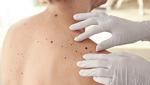 Düzensiz ve asimetrik benlere dikkat