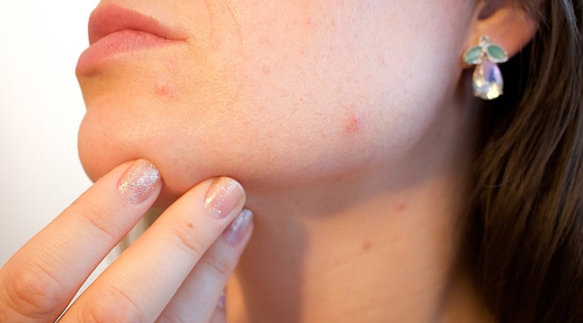 Dermatolojik hastalıklara dikkat!