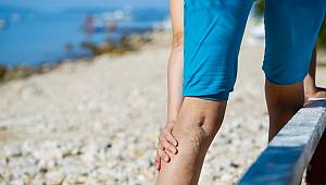 Sıcaklık artmadan varis tedavinizi yaptırın