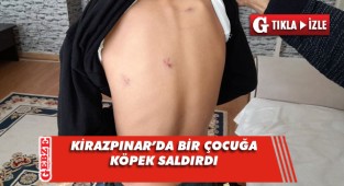 Kirazpınar'da bir çocuk köpeğin saldırısına uğradı