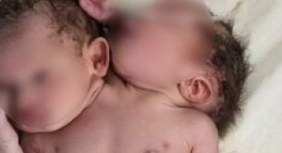 2 başlı 3 kollu bebek dünyaya geldi!