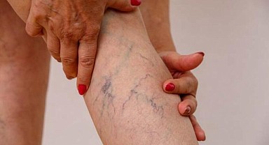 Varisten korunmak için önlem, kurtulmak için uzman yardımı alın