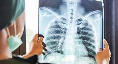 Akciğer kanserinde yeni tedavi yöntemi