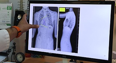 Çocuklarda ergenlik öncesi skolyoz kontrolü, tedavi şansını artırıyor!
