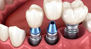 Her diş kaybı implant gerektirir!