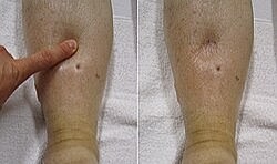 Ödemle baş etmenin etkili yolları