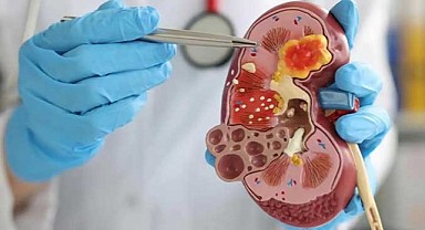 Yetersiz su tüketimi böbrek taşına yol açabiliyor!