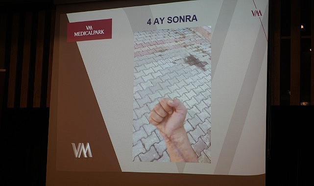 Erken müdahale uzvun durumunu belirliyor!